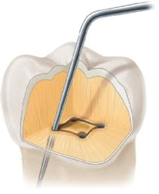 Waldent Endodontic explorer DG 16 (15/725)