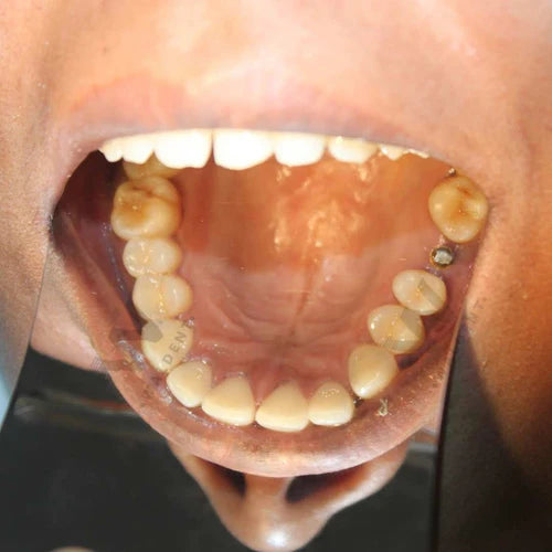 Waldent Photographic Mirror stainless steel set of 3 (K30/1)